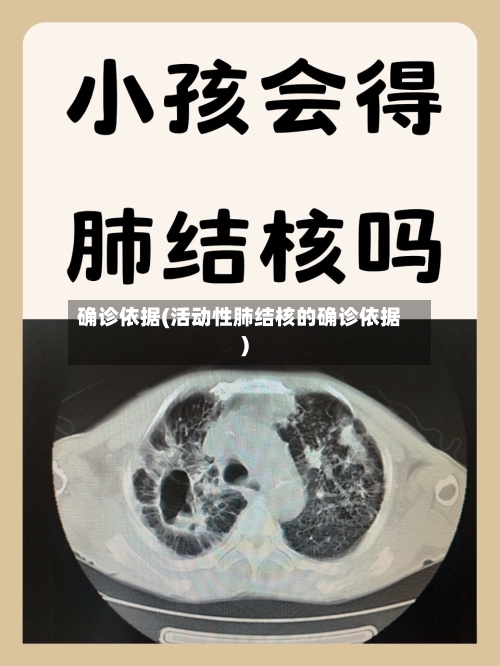 确诊依据(活动性肺结核的确诊依据)-第3张图片